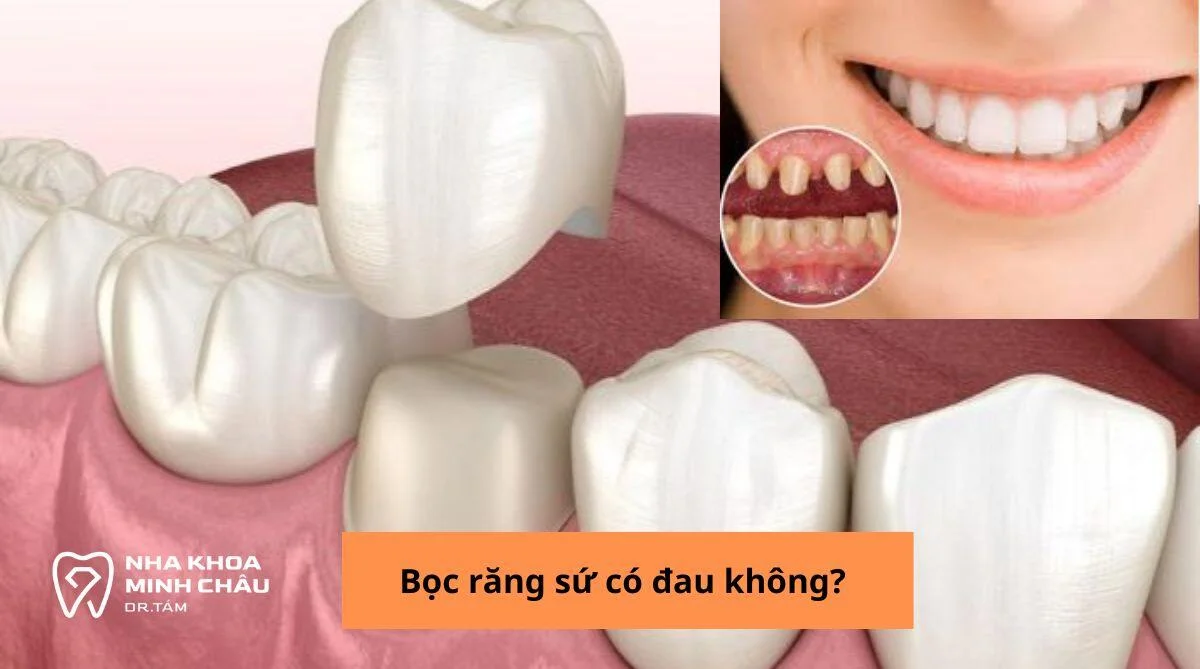 Bọc răng sứ có đau không? Kinh nghiệm và địa chỉ uy tín