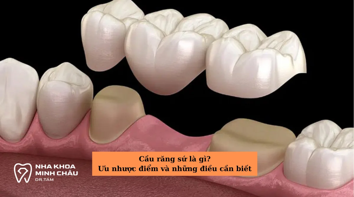 Cầu răng sứ là gì? Ưu nhược điểm và những điều cần biết