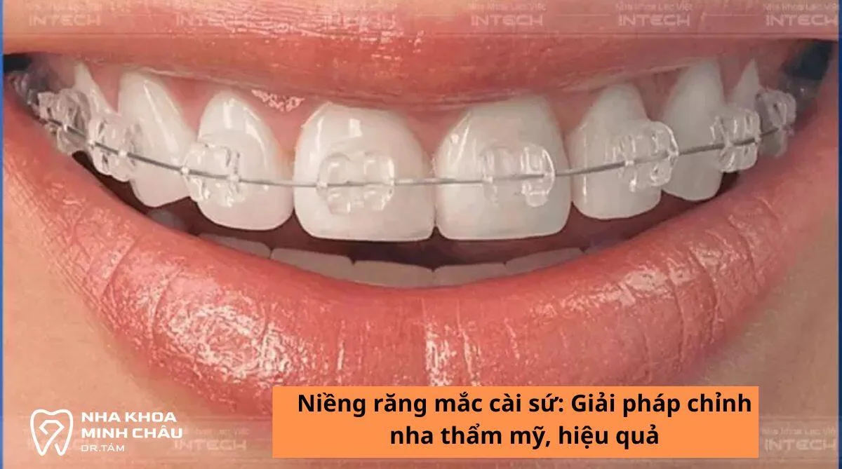 Niềng răng mắc cài sứ: Giải pháp chỉnh nha thẩm mỹ, hiệu quả