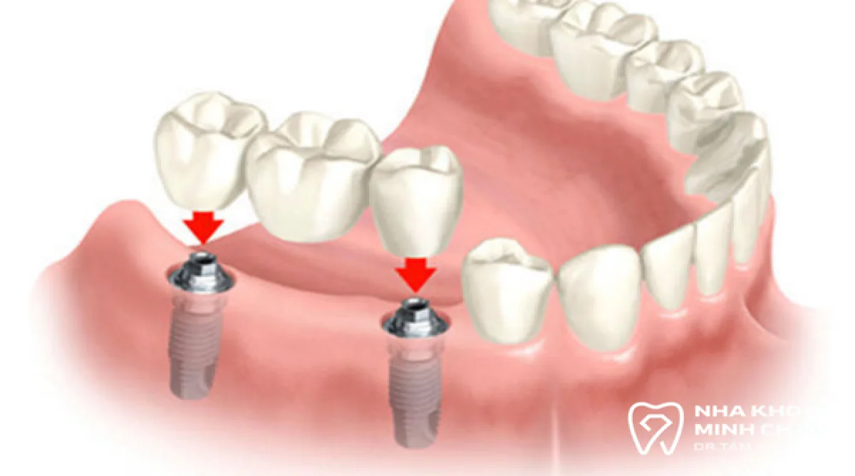Implant là gì? Cấu tạo và lý do nên chọn cấy ghép implant
