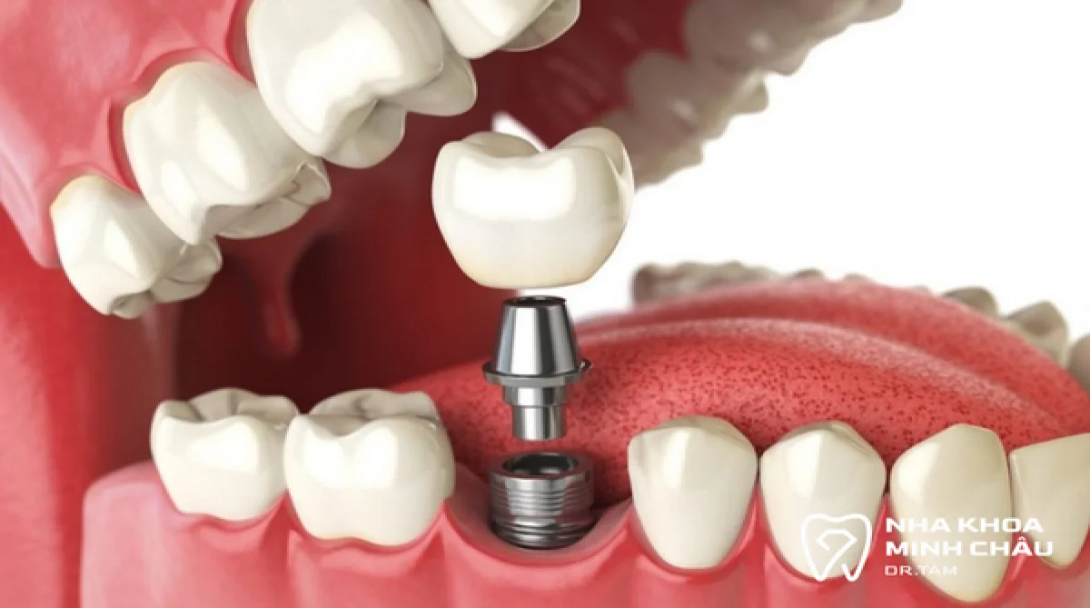 Trồng răng Implant có đau không? Giải đáp từ chuyên gia