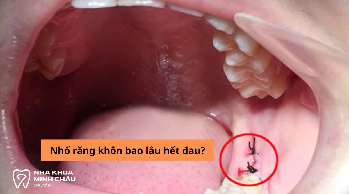Nhổ răng khôn bao lâu hết đau? Lịch trình phục hồi chi tiết từ A-Z