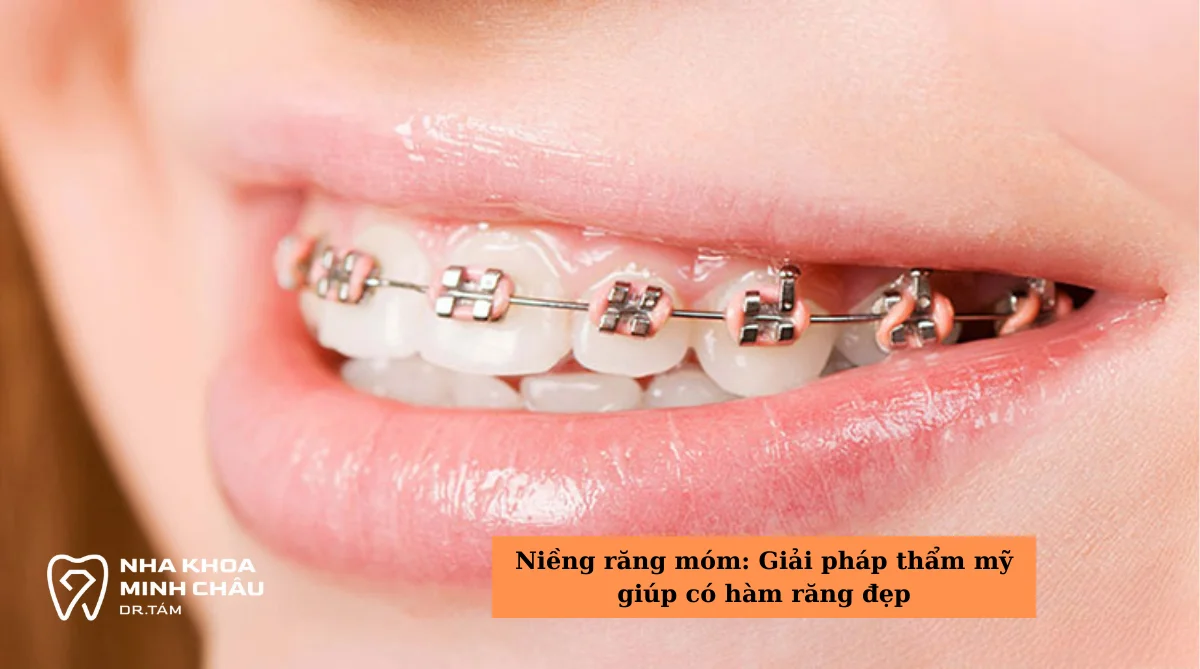 Niềng răng móm: Giải pháp thẩm mỹ giúp có hàm răng đẹp