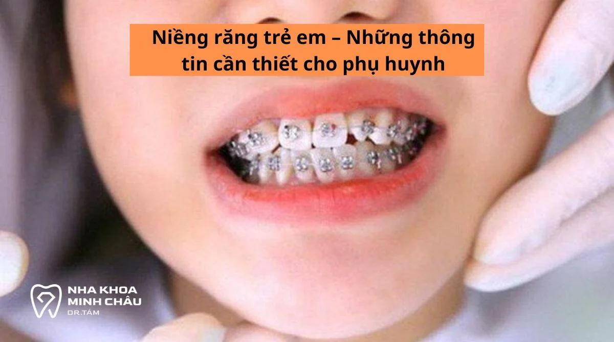 Niềng răng trẻ em – Những thông tin cần thiết cho phụ huynh