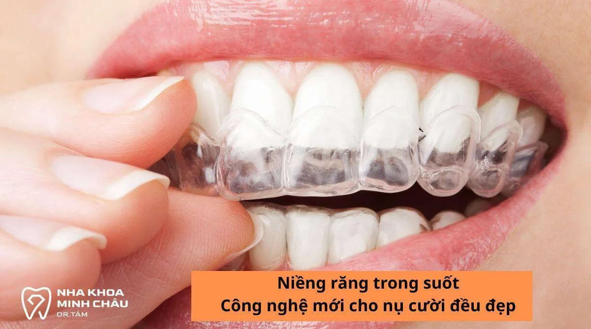Niềng răng trong suốt: Công nghệ mới cho nụ cười đều đẹp