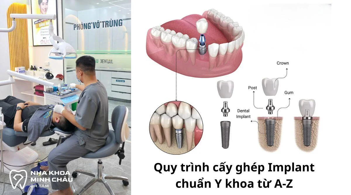 Khám phá quy trình cấy ghép Implant chuẩn Y khoa từ A-Z