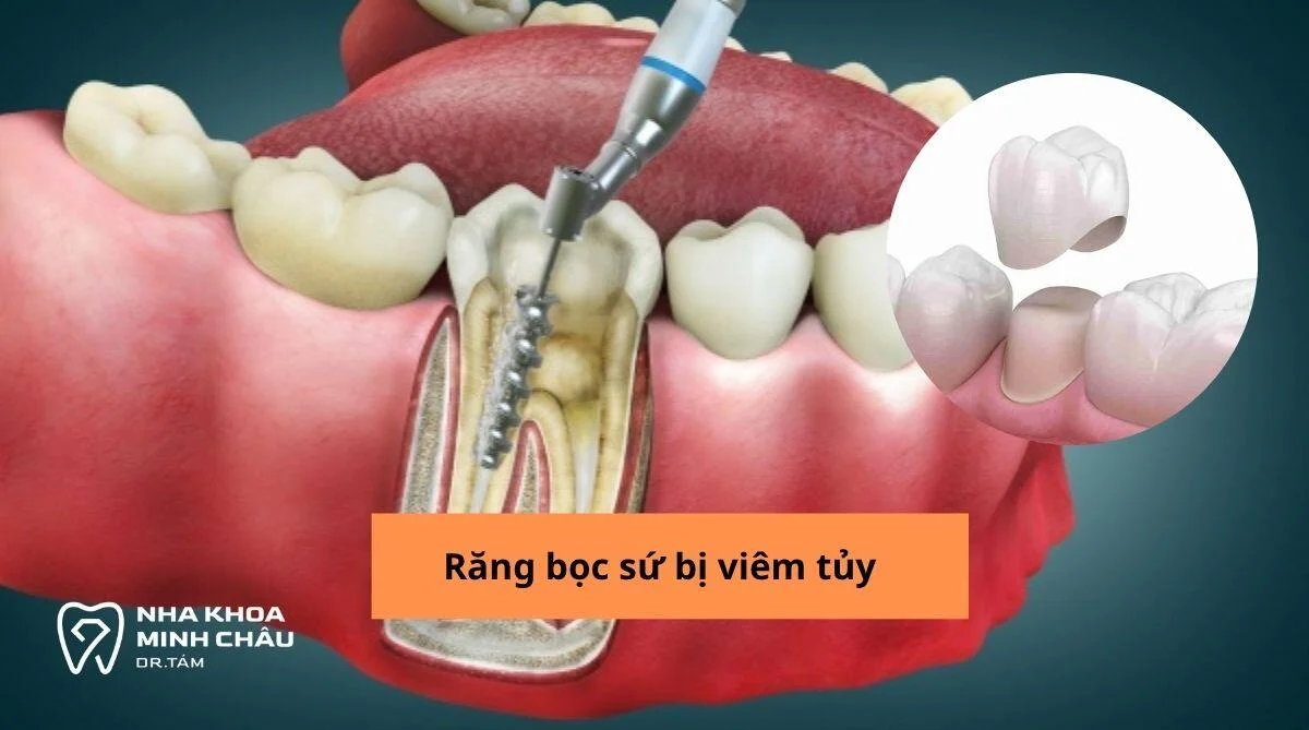 Răng bọc sứ bị viêm tủy: Nguyên nhân, Dấu hiệu và Cách điều trị triệt để