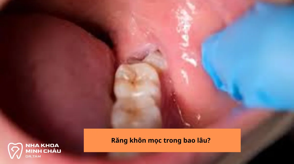 Răng khôn mọc trong bao lâu? Khi nào thì mọc xong hoàn toàn răng số 8?