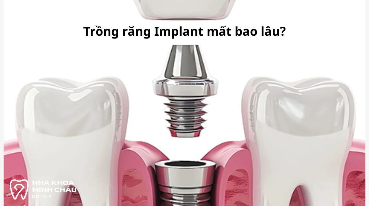 Trồng răng Implant mất bao lâu? Giải đáp thời gian chi tiết từ A-Z