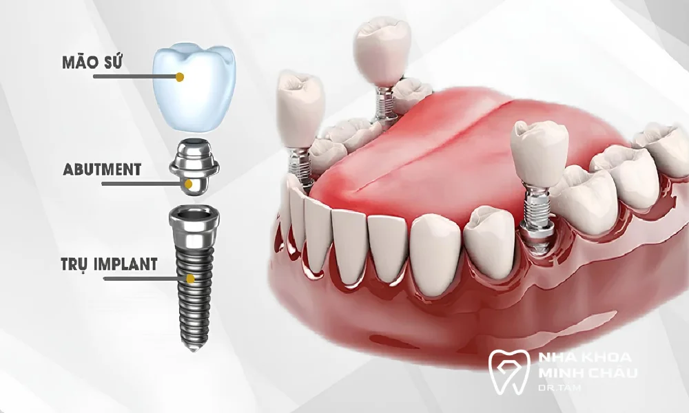 Cấu tạo của một chiếc răng implant