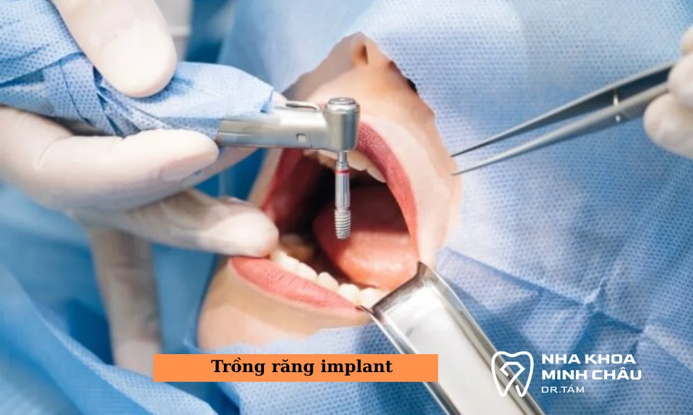 Trồng răng Implant