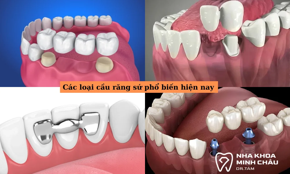 Các loại cầu răng sứ phổ biến hiện nay
