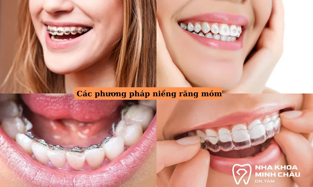 Các phương pháp niềng răng móm phổ biến hiện nay