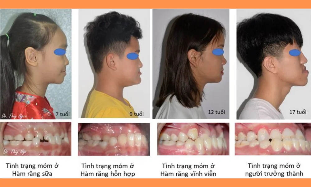 Các tình trạng móm răng bạn cần biết