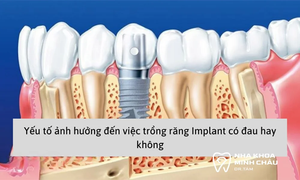 Các yếu tố ảnh hưởng đến việc trồng răng implant có đau hay không?