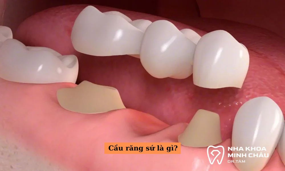 Cầu răng sứ là gì