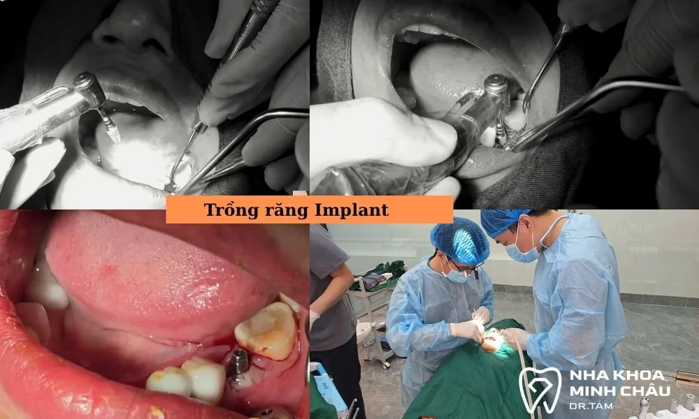 Cấy ghép trụ Implant