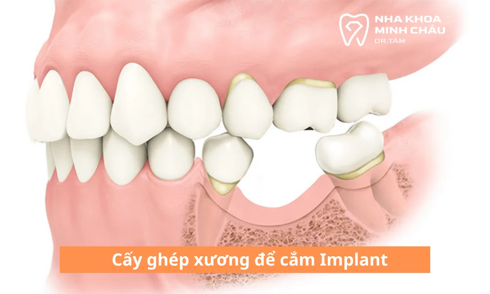 cấy ghép xương để cắm Implant