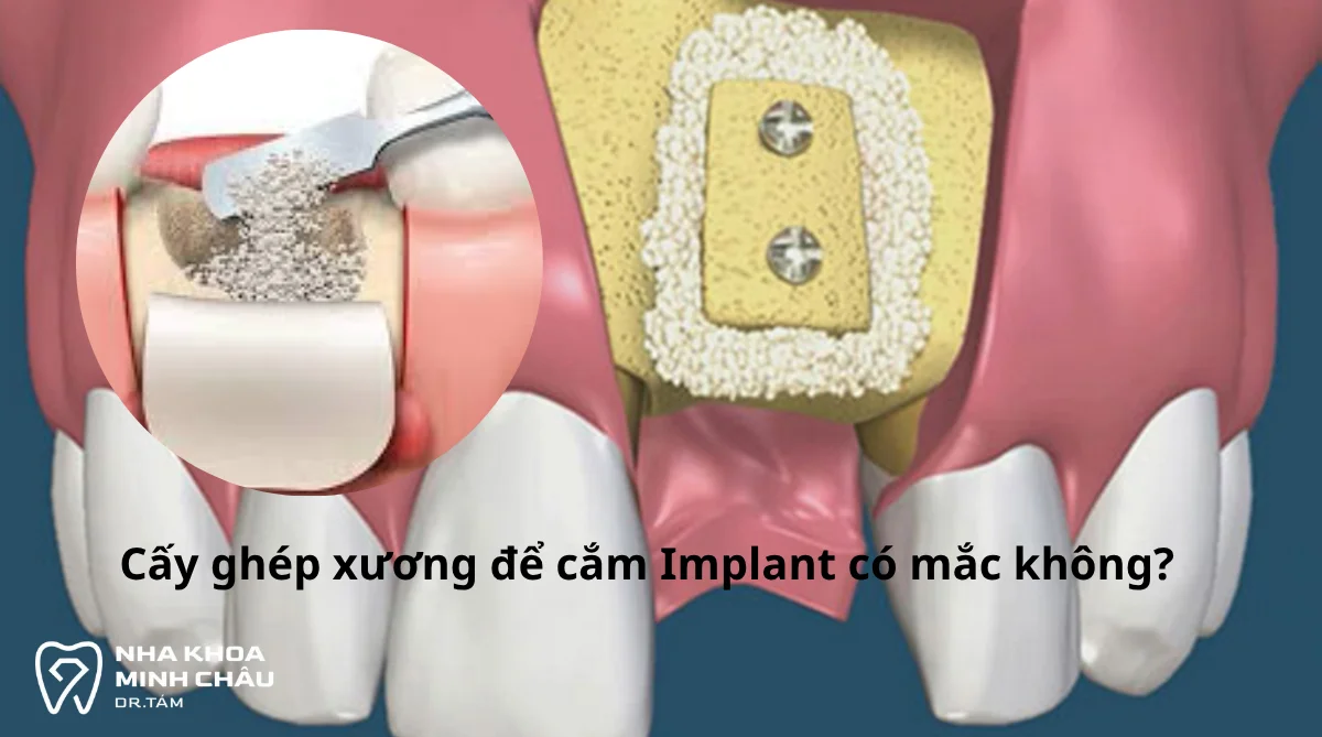 Cấy ghép xương để cắm Implant có mắc không? Giá bao nhiêu?