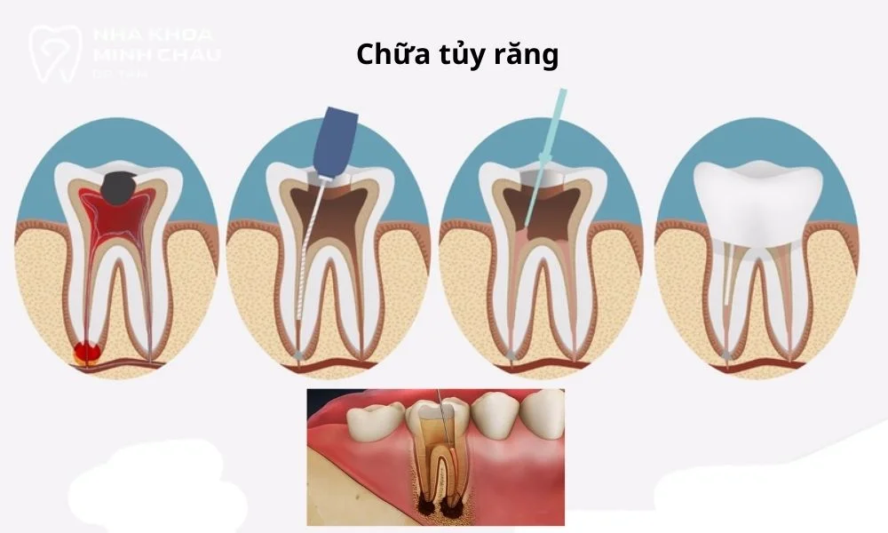 Điều trị tủy răng