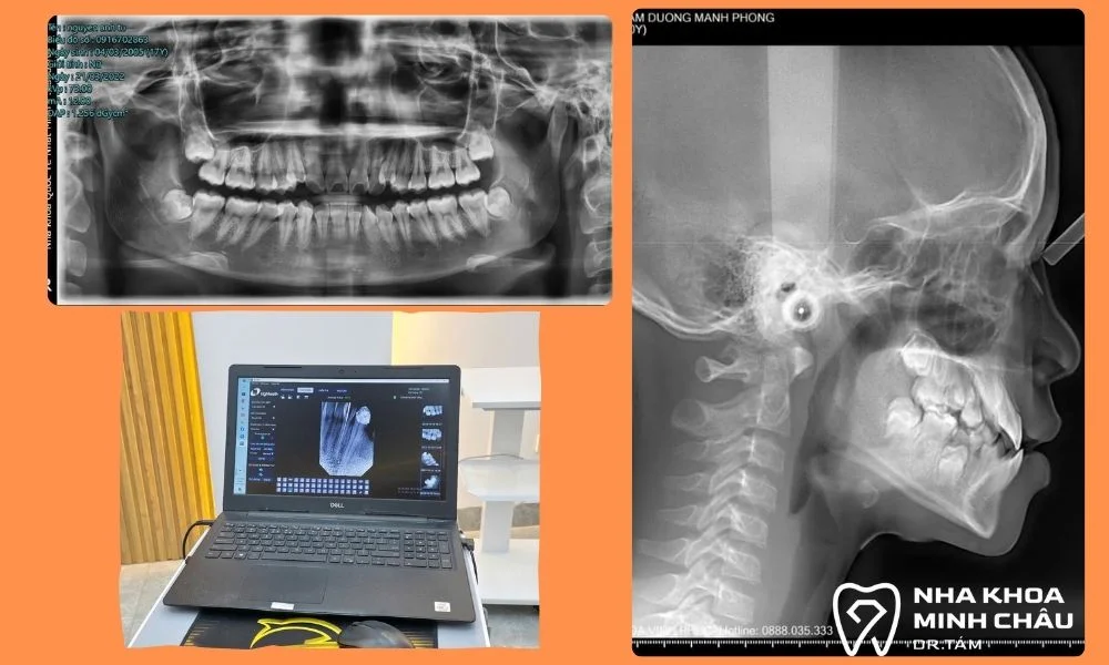 Chụp X-quang răng