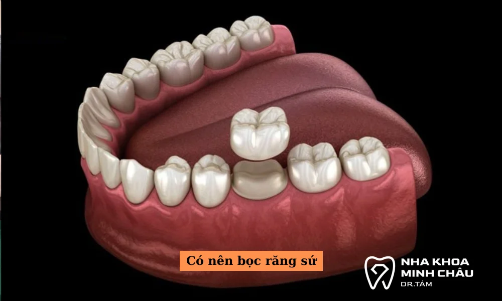 Có nên bọc răng sứ không?