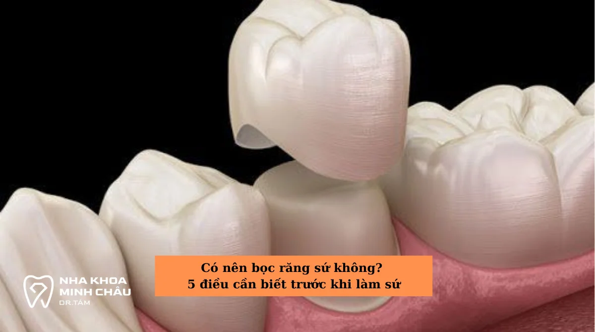 Có nên bọc răng sứ không? 5 điều cần biết trước khi làm sứ