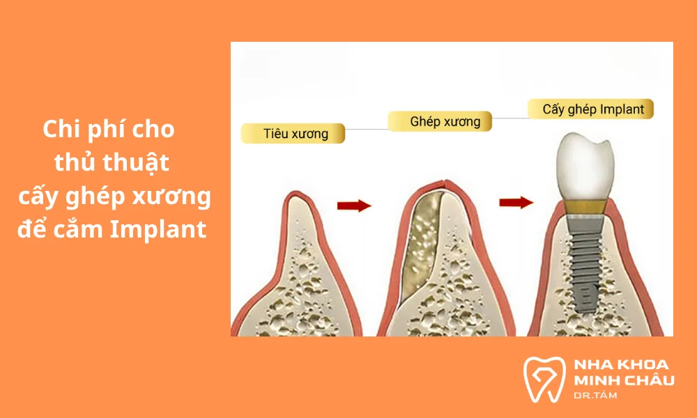Giá thủ thuật cấy ghép xương để cắm Implant
