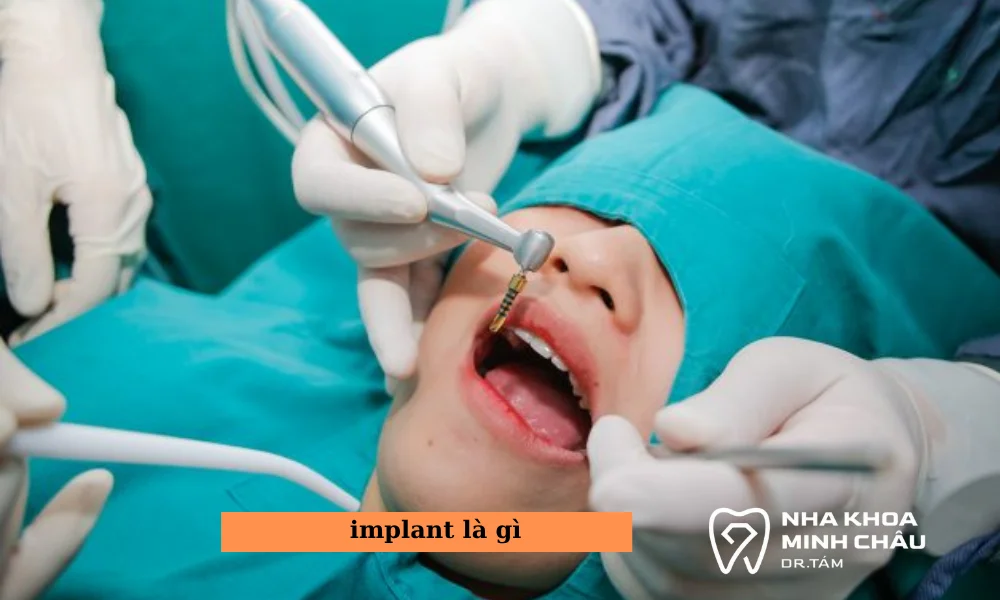 implant là gì?
