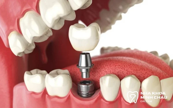 Trồng răng Implant có đau không? Giải đáp từ chuyên gia