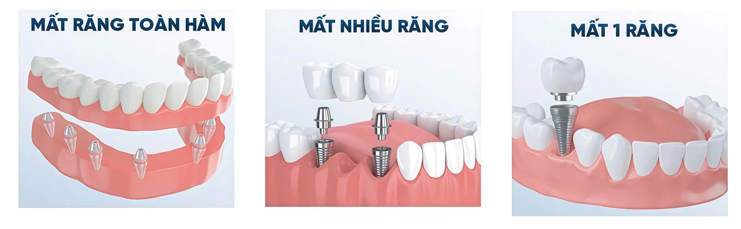 Một số trường hợp nên trồng răng Implant