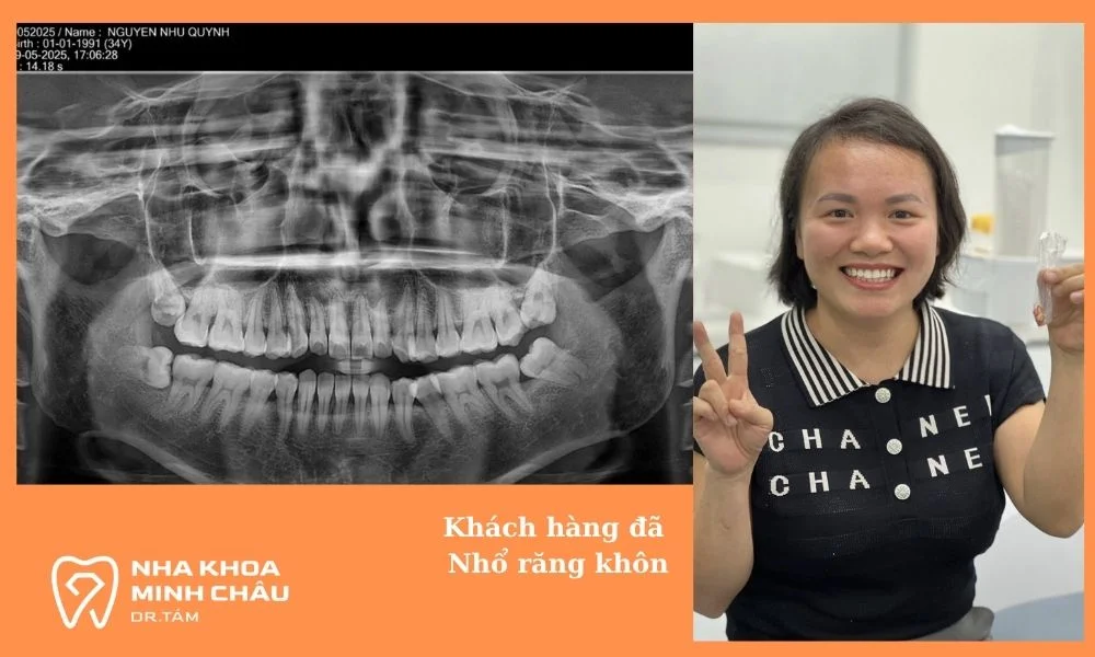 Khách hàng đã nhổ răng khôn tại Nha khoa Minh Châu DR Tám