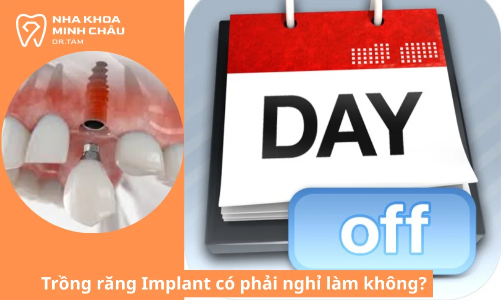 Bạn không cần nghỉ làm khi trồng răng Implant