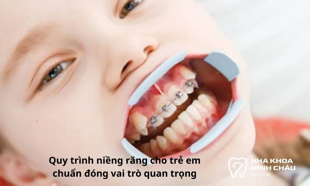 Kỹ thuật niềng răng cho trẻ em đóng vai trò quan trọng tạo hình răng