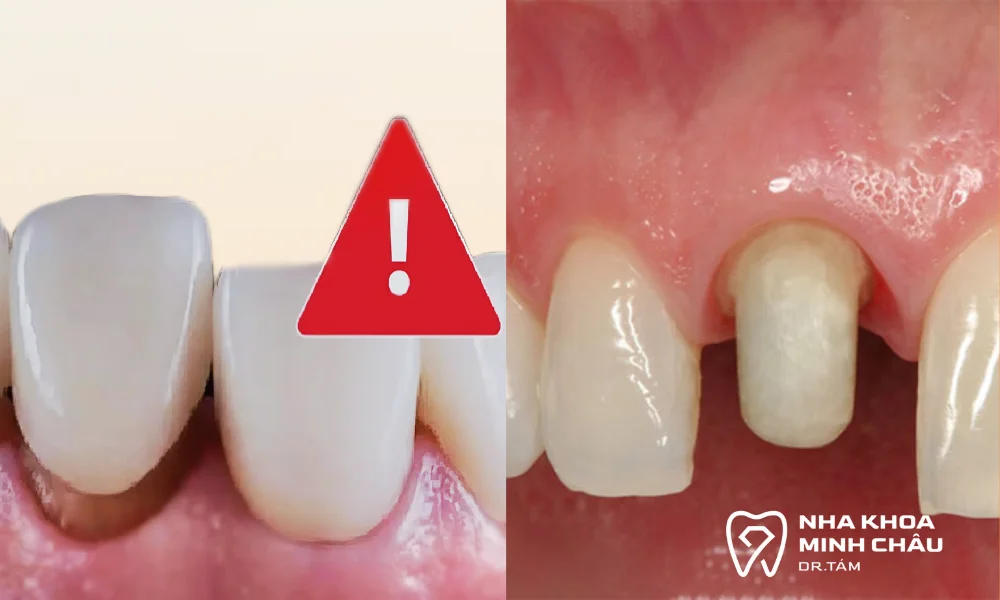 Kỹ thuật thực hiện kém (Lỗi từ nha khoa)