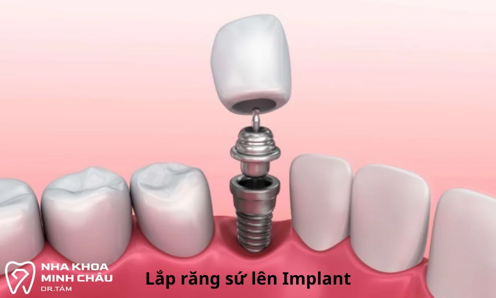 Lắp răng sứ vào trụ Implant