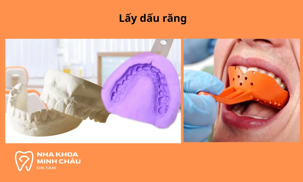 Sau khi mài cùi, bác sĩ sẽ tiến hành lấy dấu hàm