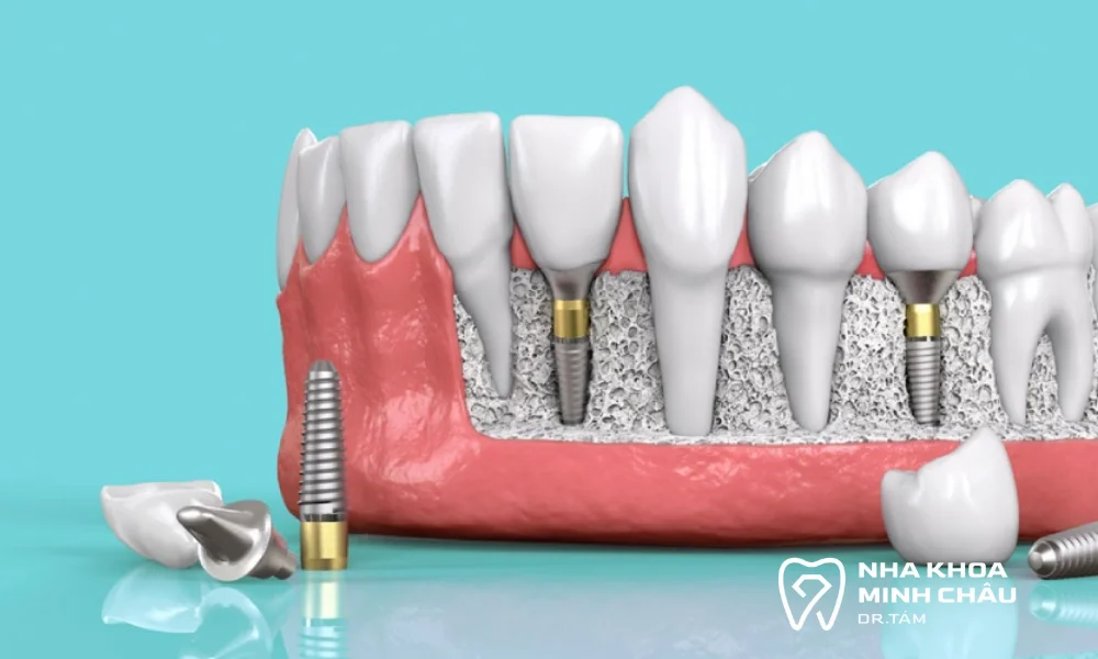 Lợi ích của phương pháp implant