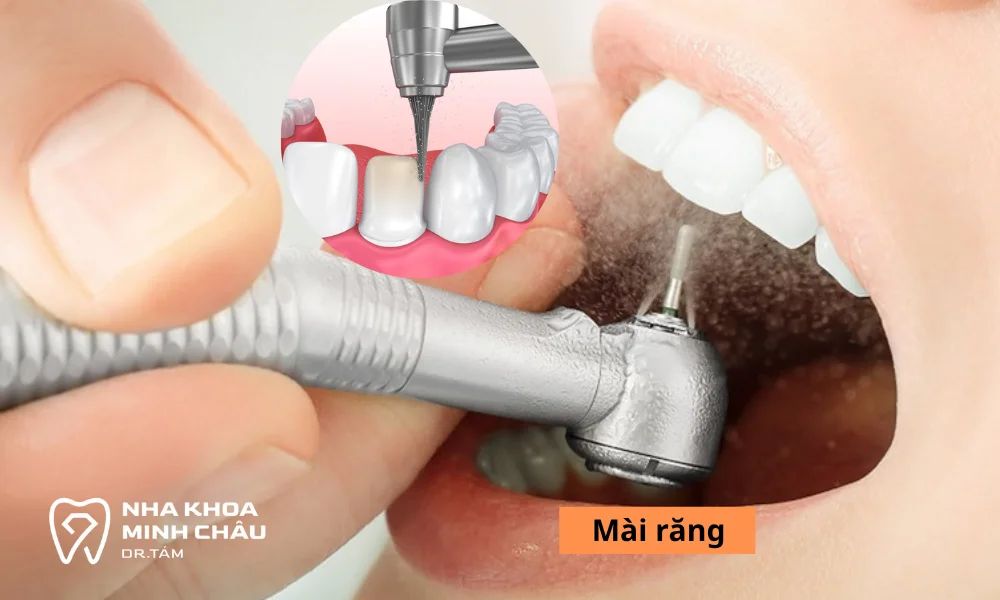 Kỹ thuật mài răng của Bác sĩ có ảnh hưởng đến sự ê răng của bạn