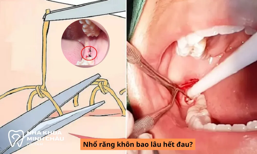 Nhổ răng khôn bao lâu hết đau