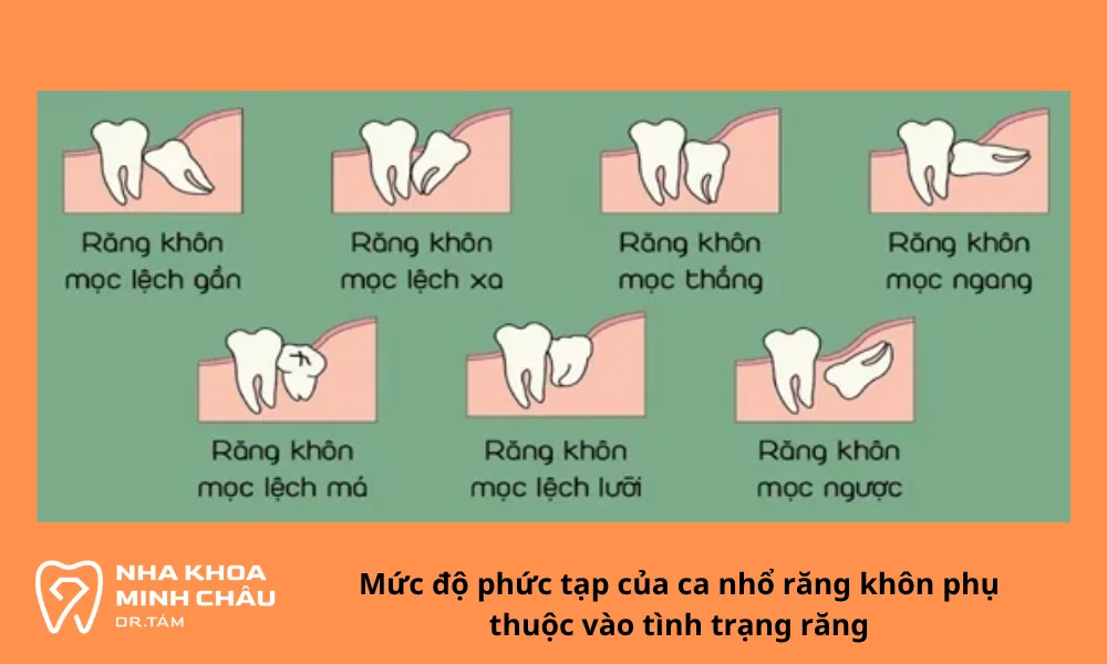 Mức độ phức tạp của ca nhổ răng khôn phụ thuộc vào tình trạng răng