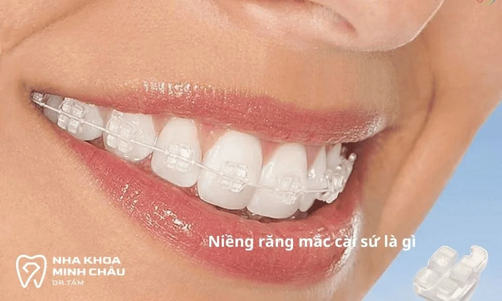 Niềng răng mắc cài sứ