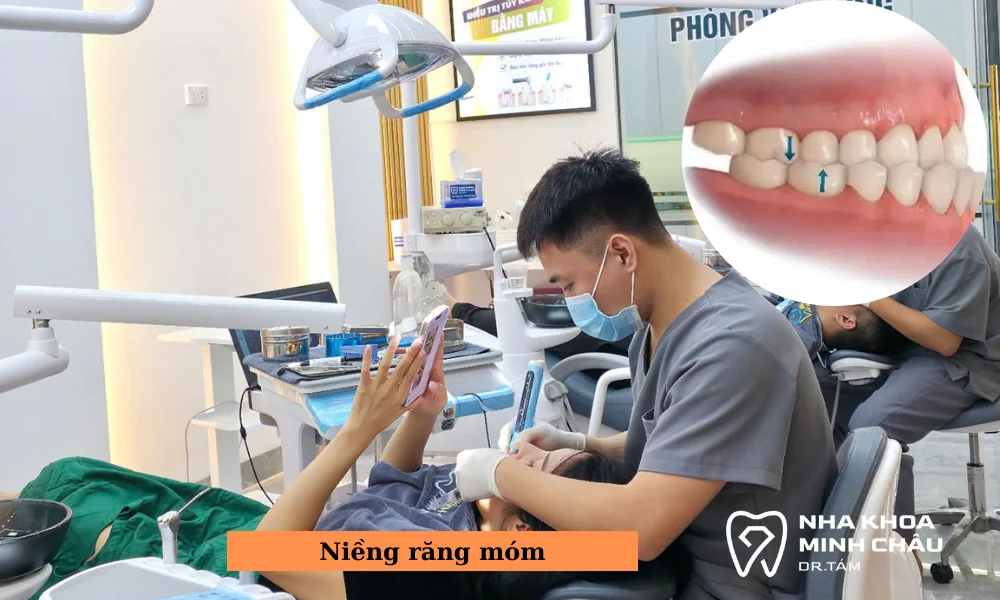 Niềng răng móm