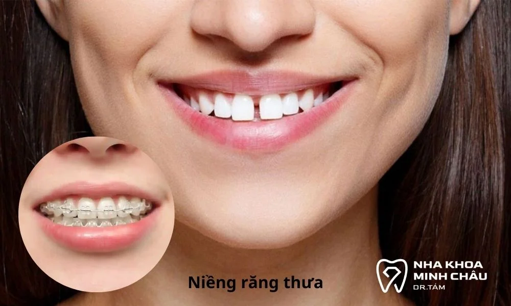 Giải pháp thẩm mỹ cho răng thưa