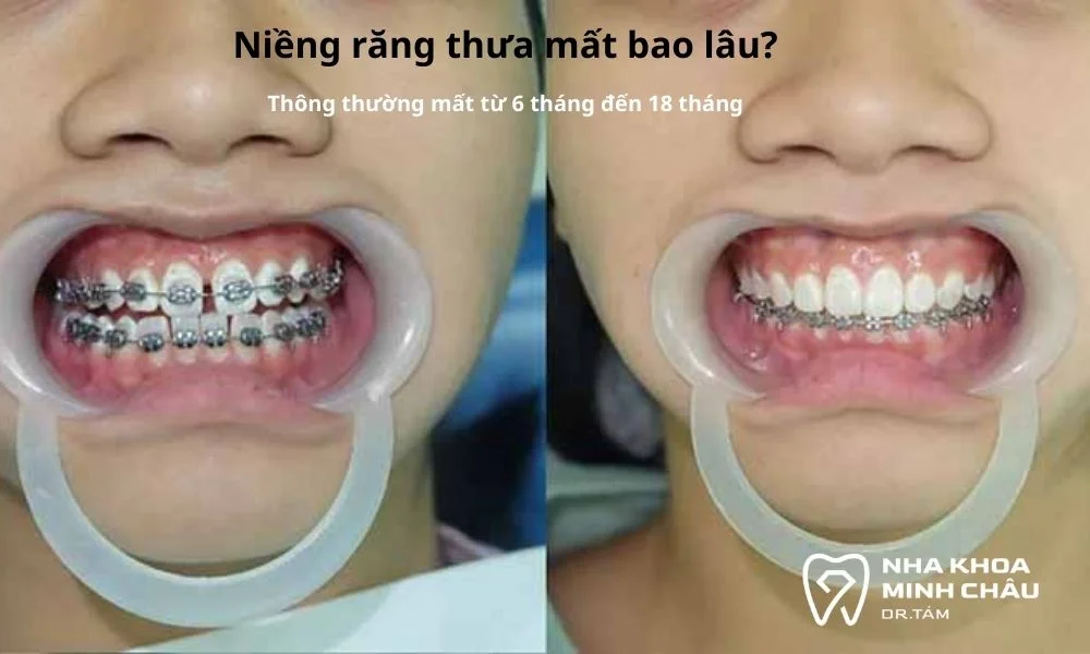 Thời gian niềng răng thưa