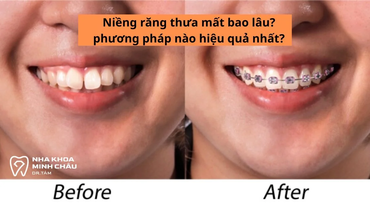 Niềng răng thưa mất bao lâu? phương pháp nào hiệu quả nhất?