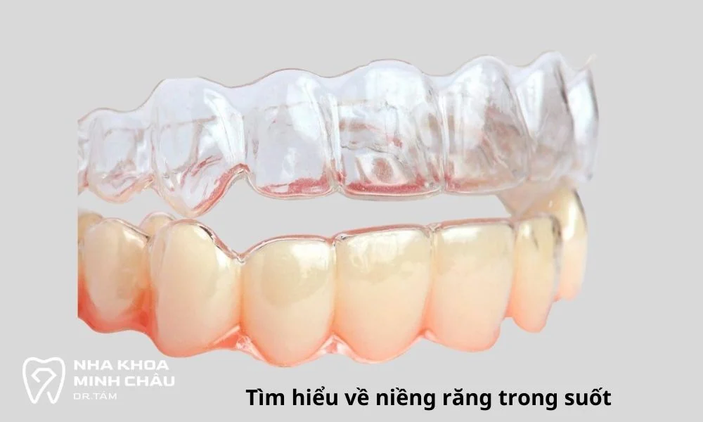 Niềng răng trong suốt