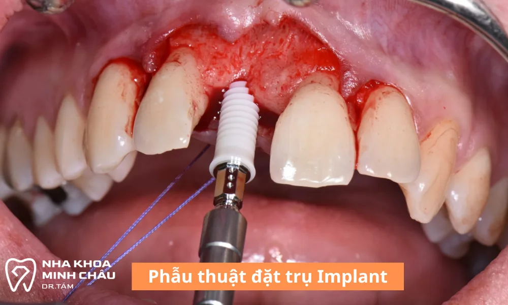 Phẫu thuật đặt trụ Implant