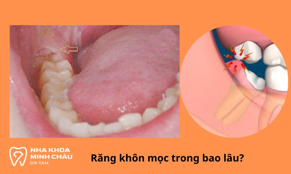 răng khôn mọc trong bao lâu?