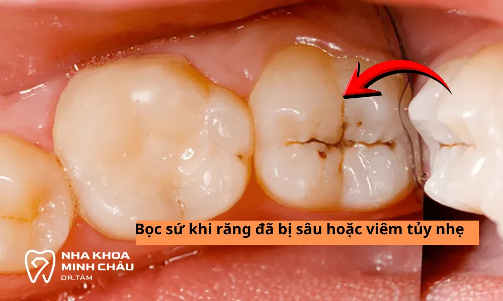 bọc sứ khi răng đã bị sâu hoặc viêm tủy nhẹ